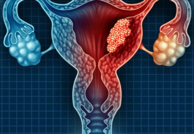 Cervical Cancer
